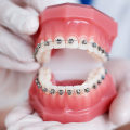 A Complete Guide to Braces: Straightening Your Teeth for a Perfect Smile