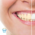 Maximizing Your Smile: A Guide to Preparing Your Teeth for Cosmetic Dentistry