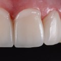 Cosmetic Enhancements: Improving Your Smile with Dental Bonding