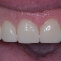 Closing Gaps Between Teeth: A Comprehensive Guide to Cosmetic Dentistry