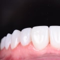 Shaping and Polishing for a Perfect Smile