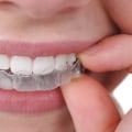 All About Invisalign Clear Aligners: A Complete Guide to Teeth Straightening