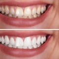 Avoiding Staining or Damage: Tips for Maintaining a Beautiful Smile