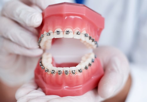 A Complete Guide to Braces: Straightening Your Teeth for a Perfect Smile