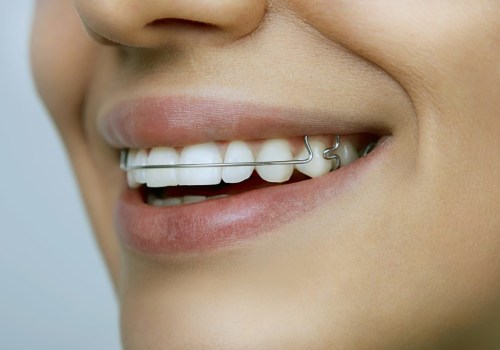 A Complete Guide to Retainers for Teeth Straightening