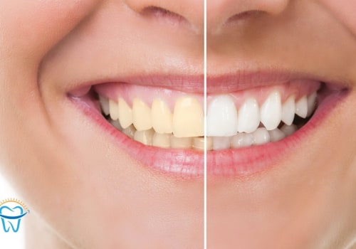 Maximizing Your Smile: A Guide to Preparing Your Teeth for Cosmetic Dentistry