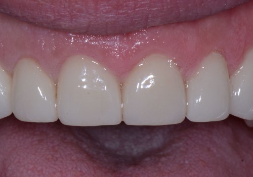 Closing Gaps Between Teeth: A Comprehensive Guide to Cosmetic Dentistry