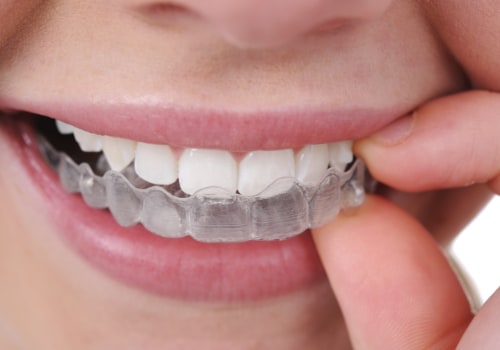 All About Invisalign Clear Aligners: A Complete Guide to Teeth Straightening